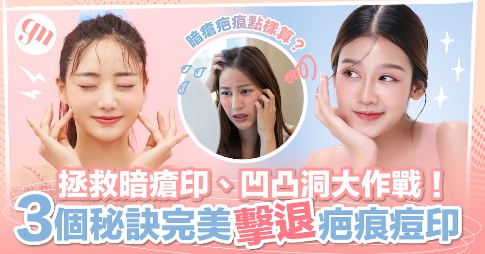 拯救暗瘡印、凹凸洞大作戰！用極護膚品都冇用？3個秘訣完美擊退疤痕痘印